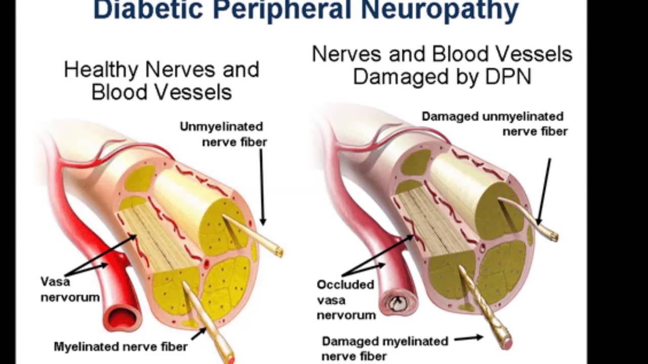 Diabetic Peripheral Neuropathy